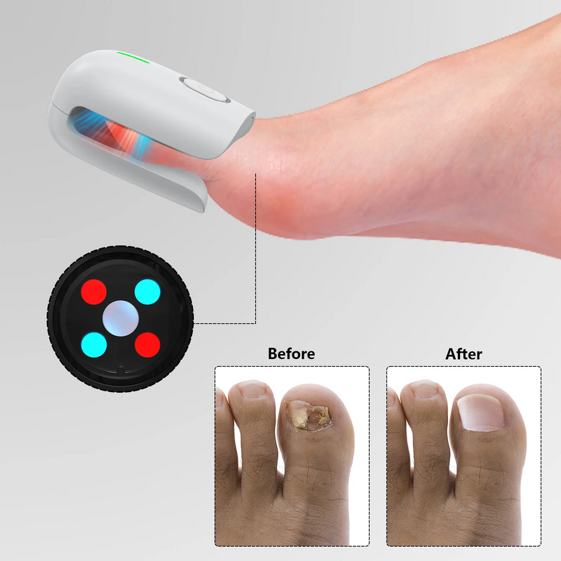 Portable Nail Fungus Removal Device – Treat Nail Discoloration and Thickening Safely at Home with Advanced Anti-Fungal Technology