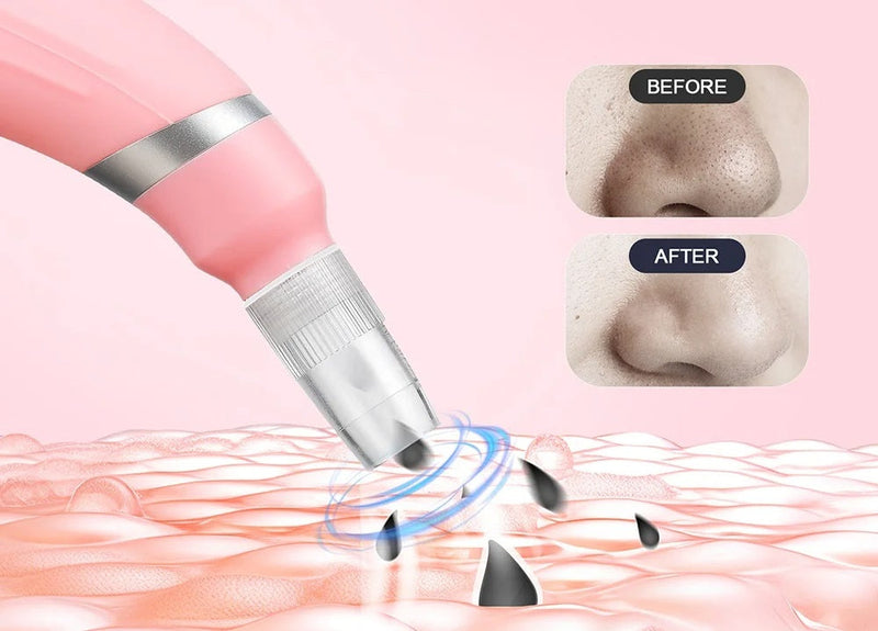 Diamond Microdermabrasion Facial Device - Portable Exfoliation Vacuum for Deep Cleaning, Blackhead Removal, and Glowing Skin Care