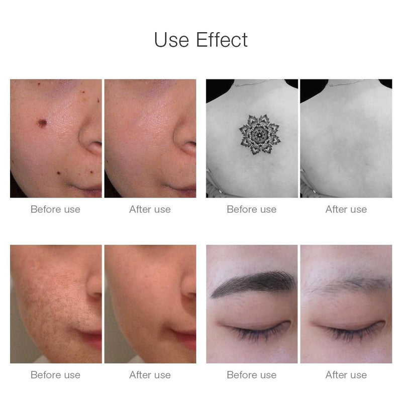 Professional Laser Pen Tattoo Removal, Mole, Freckles, Acne removal